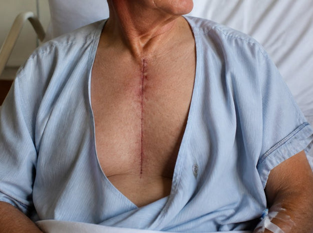 Sternal Nonunion: Prevention After Heart Surgery