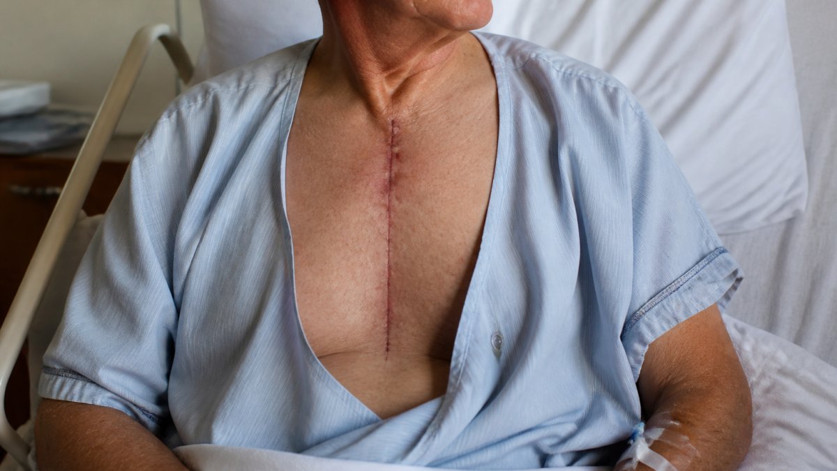 Sternal Nonunion: Prevention After Heart Surgery